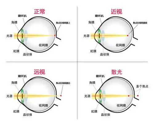 还没到眼底就已经聚焦,就会形成近视;反之聚焦在视网膜后就会,就