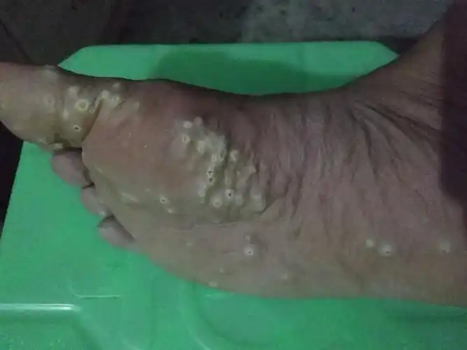 右脚底板长肉疮越长越多又痒又痛是什么病