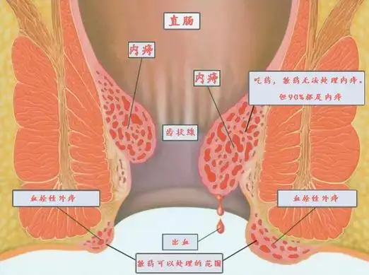 p>内痔疮简称内痔称为肛垫,对精确控制大便及肛门排气有非常重要的