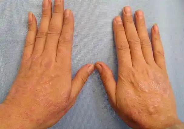 治疗皮肤癣有效的产品,银屑病早期症状图片