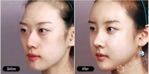 韩式精雕美鼻:misko鼻部塑形