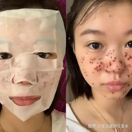 宁波激光祛斑效果怎么样术后3个月轻松get无暇肌肤