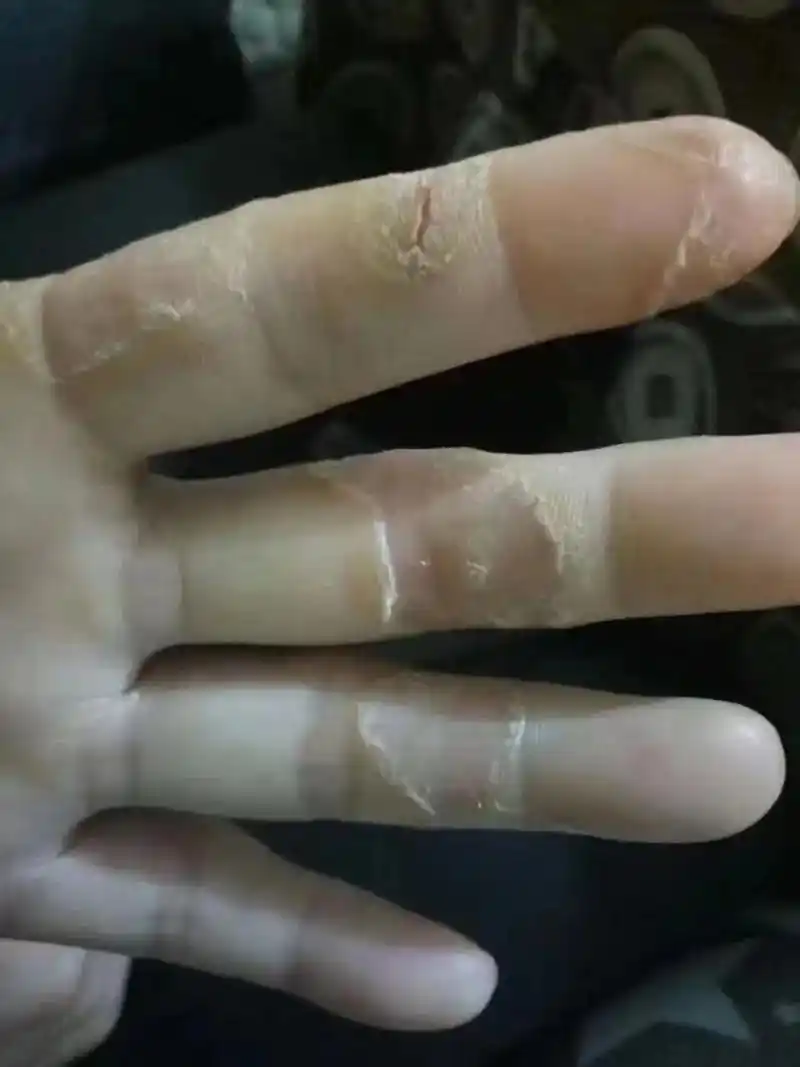 手癣一种让很多人惧怕的皮肤病,人们之所以惧怕是因为其是一种传 - 抖