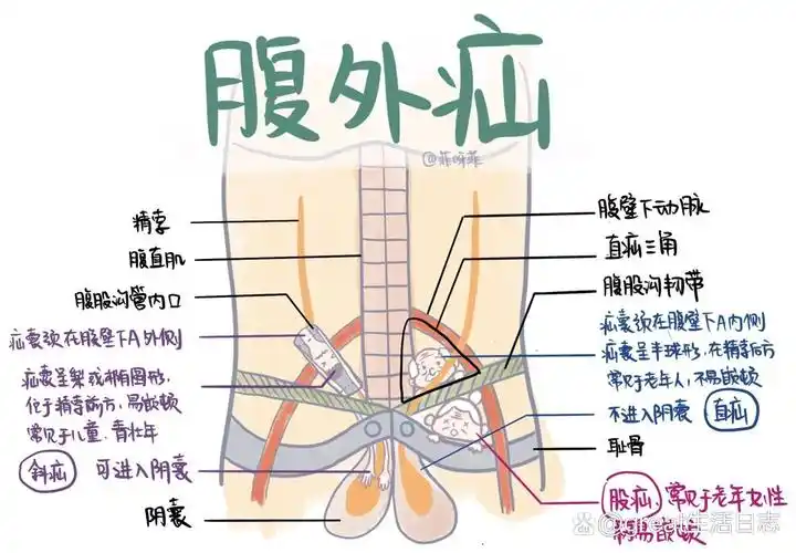 医学生笔记9999697115腹外疝-腹股沟疝&股疝