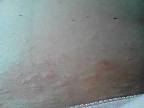 最近几天乳房周围还有乳房下边一到晚上就很痒,一抓就起很多小红疙瘩