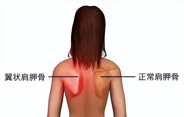 方法一:自然站立,身体放松,从正后方观察双侧肩胛骨是否平贴在后背上