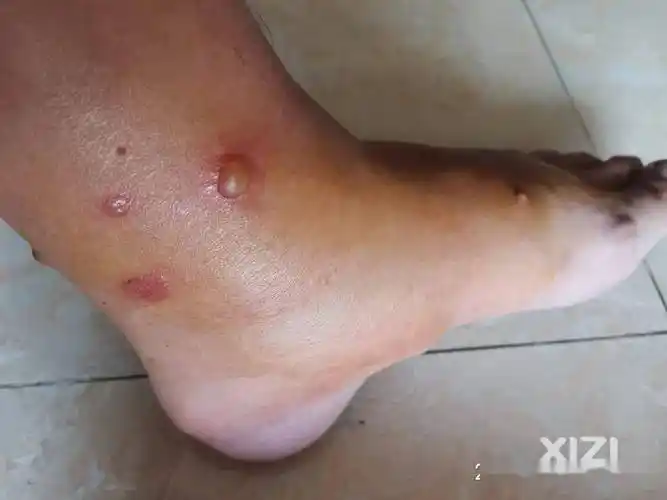 西友提醒大家红蚂蚁毒性太大,请大家行走小心.