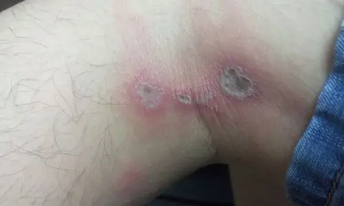 不知道被什么虫子咬了,第二天发现起水泡了,肌肉里面水肿了,请问怎