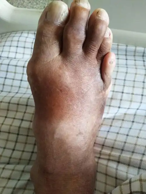 单源能谱ct在检查痛风石中的应用