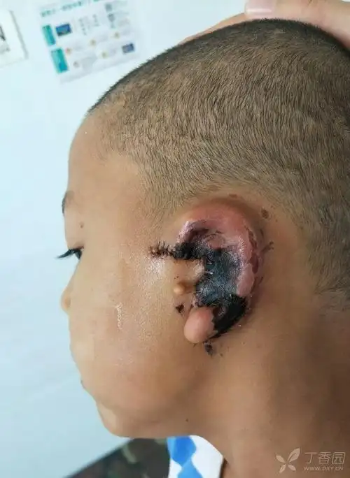 【讨论】先天性小耳畸形一期术后部分皮肤坏死,求处理意见