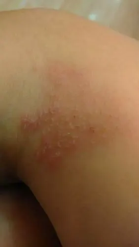 有谁知道这身上长了好多这种小水泡是咋回事啊?怎么弄?