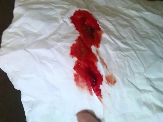 问:自己一年前去检查发现长了内痔,前天大便出血还带有血块昨天血丝都