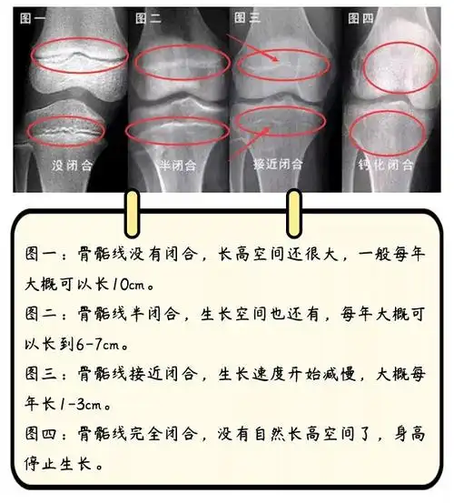 渭南测儿童骨龄哪个医院可以