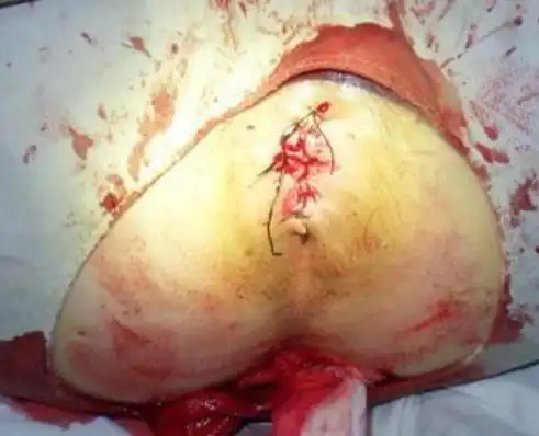 血栓性外痔图片56