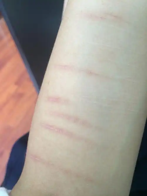 手臂上的疤结痂脱落后,伤口处凸出,这种情况用红霉素软膏可以吗?