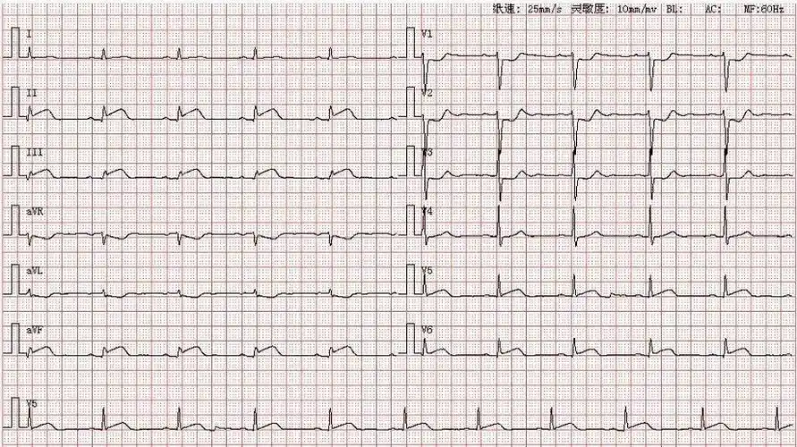 心电图图库丨心肌梗死系列