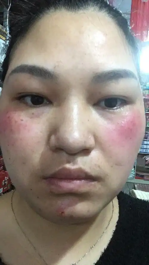 玫瑰痤疮的诊断与治疗