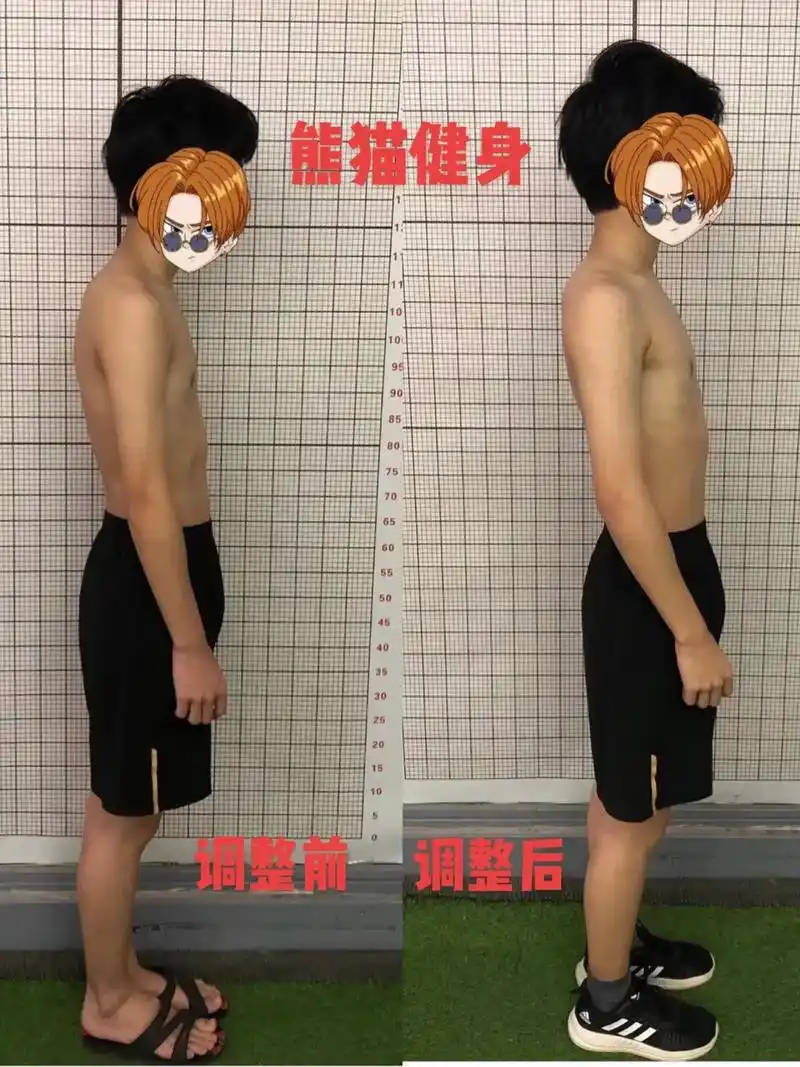 含胸驼背调整案例