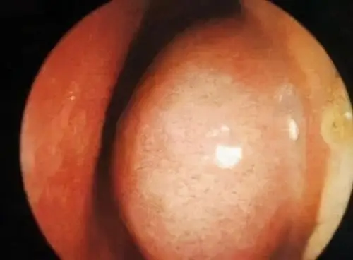 鼻粘膜水肿图片具体怎么判断呢?