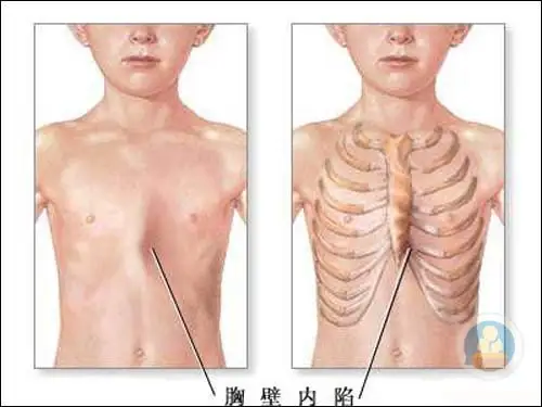 漏斗胸与佝偻病的鉴别