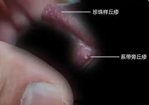 珍珠疹和系带旁腺增生