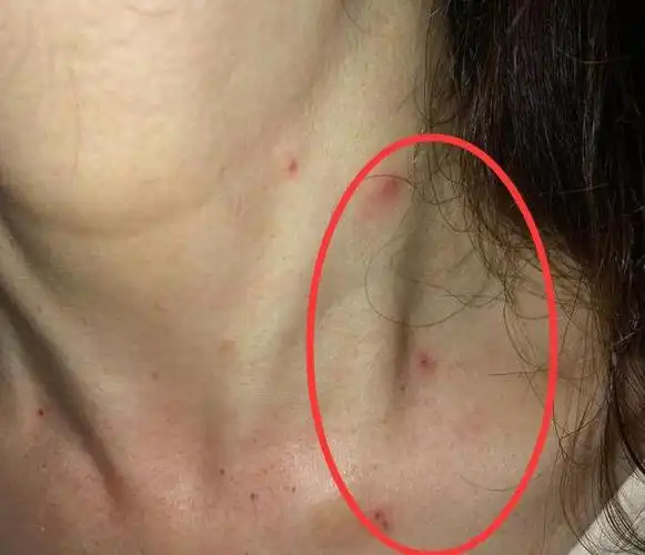 长小红点是肝病征兆医生回避这2样东西肝或慢慢好转