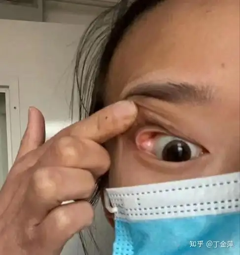 泪腺脱垂什么样?