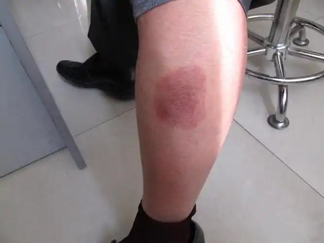 皮肤结核病图片_皮肤结核病症状表现图片大全_有来医生