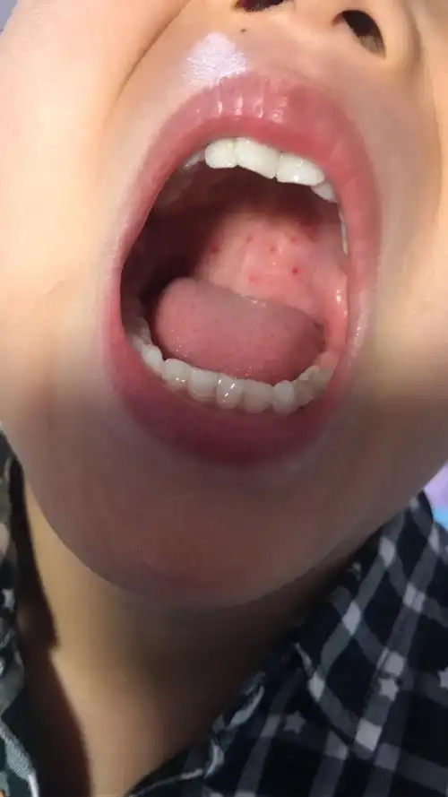 疱疹性咽颊炎并不可怕