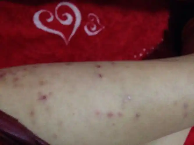 去医院看有说是丘疹有说是湿疹,还有说紫外线过敏不能晒,到现在也没