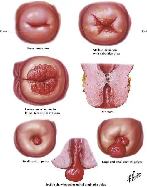 data-id="gnbq8l99fl">宫颈裂伤一般是指宫颈处超过1cm的裂伤,多发生