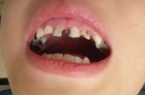 不过过分吃糖对孩子的危害尤其是牙齿的危害还是巨大的,作为家长