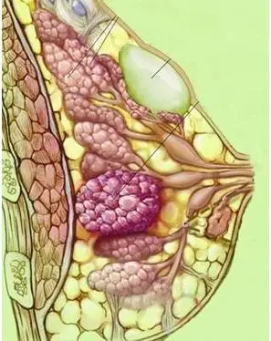乳房肿块的解读