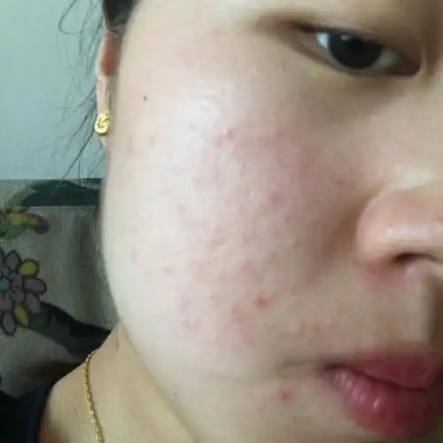 谁能看我看一下我脸上长的这种红红的小痘痘是属于什么情况?