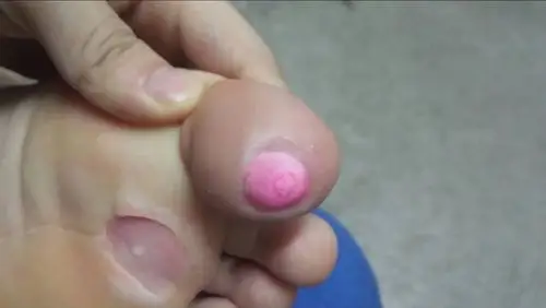 鸡眼根部挖出图片 (9)