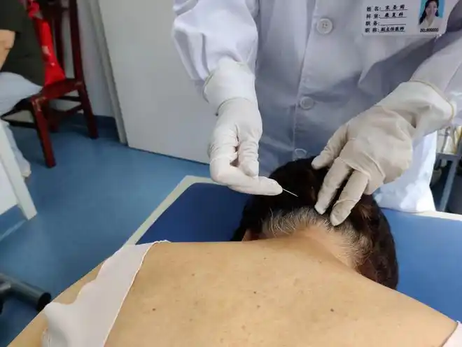 颈椎病患者接受针刀疗法10秒后即缓解