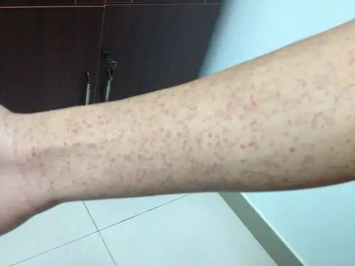 四肢躯干皮疹诊断是什么如何治疗