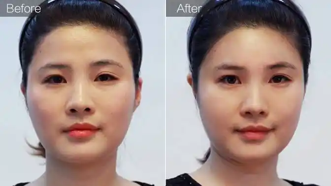 玻尿酸丰额头案例效果对比图