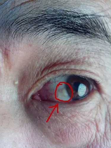 分类:眼科  2014-02-13 22:48 提问者采纳 可能是睑裂斑,如无症状,不