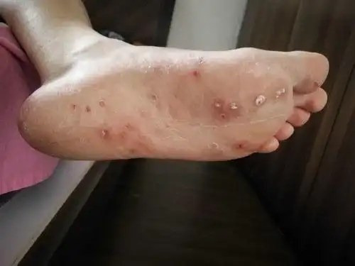 脚丫子起泡还很痒怎么回事,脚丫子起泡很痒还烂脚趾缝