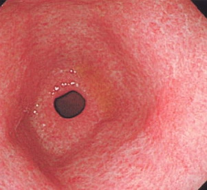 图3 慢性胃炎在胃镜检查时的"花斑"样表现(与图2正常比较观看)