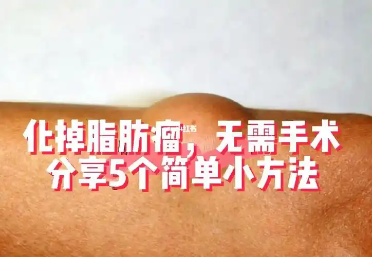 化掉脂肪瘤无需手术分享5个简单小方法