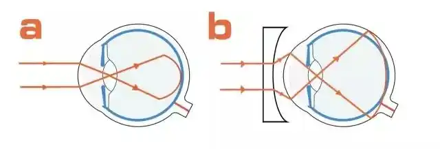 近视了眼镜戴还是不戴?为什么度数一直在加深?