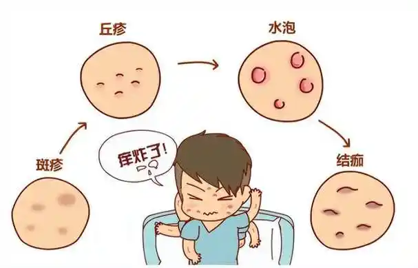 水痘传染性强预防知识快备好
