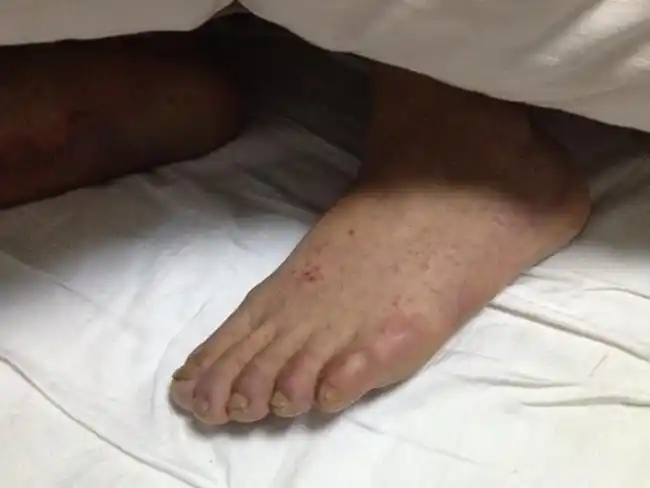 宝宝螨虫过敏症状图片