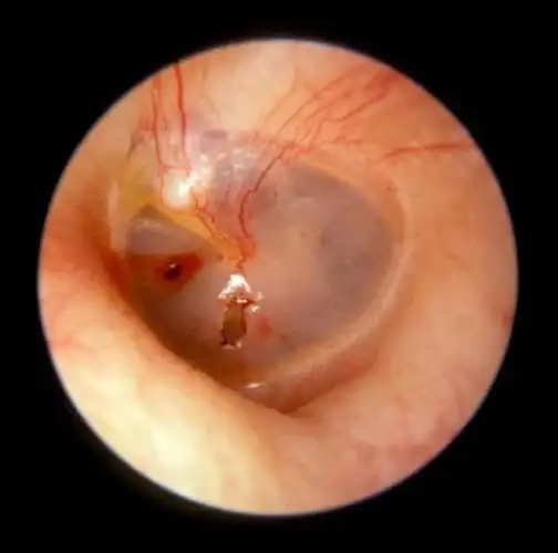 外伤使鼓膜穿孔图片