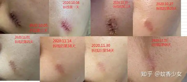 图片记录切痣术后恢复情况20