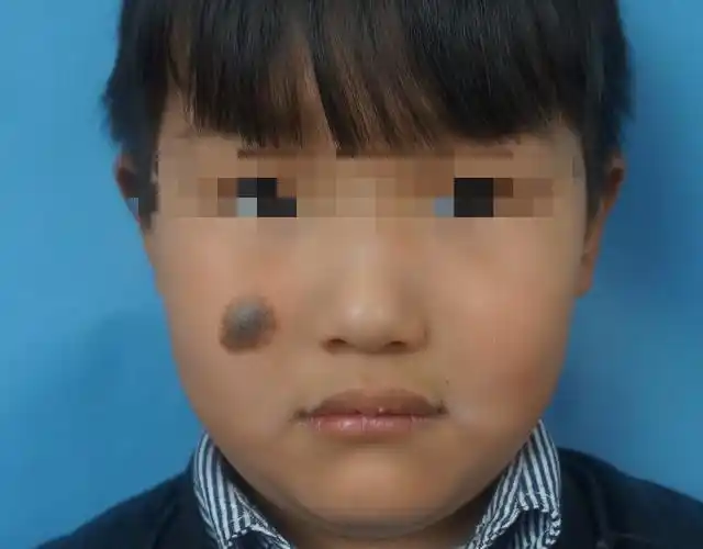 小孩一出生就有黑毛痣应该怎么办?