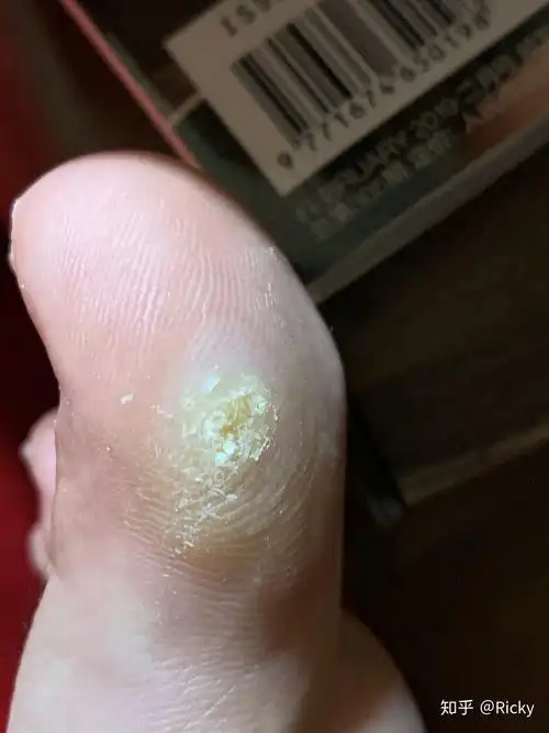 刚长出来的小跖疣怎么治