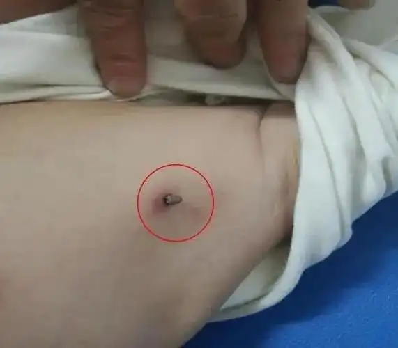 蜱虫叮咬结果在为岳母办丧事的过程中就这样丢了宝贵的生命最终因多